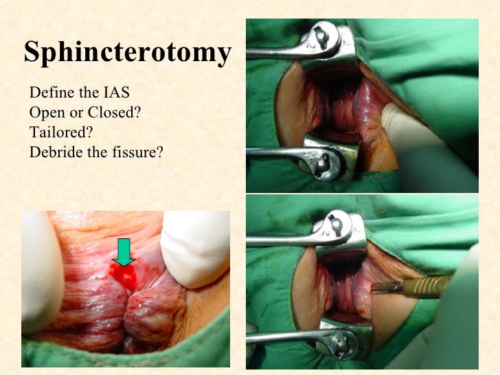 Home Safe Alarma Internal Anal Sphincterotomy